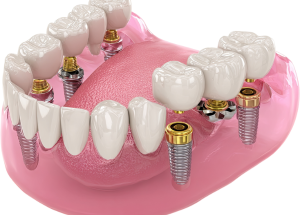 All-on-4 Dental Implants