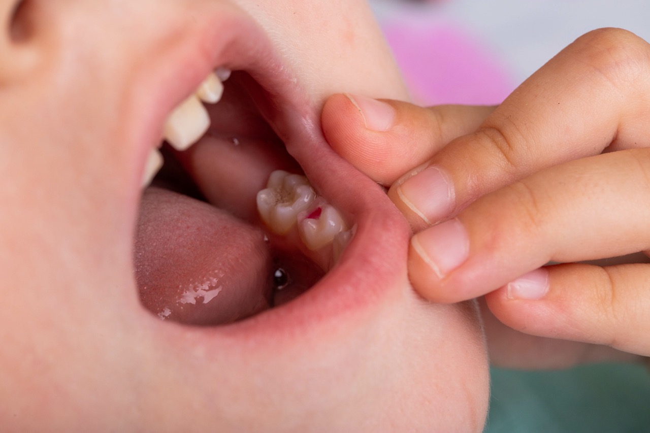 cavities in baby teeth do they need filling