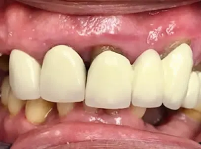 before full mouth reconstruction