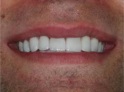 case 2 after porcelain veneers