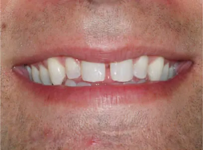 case 2 before porcelain veneers