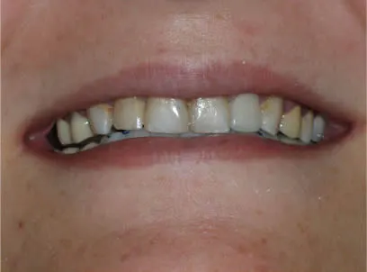 before dental crowns