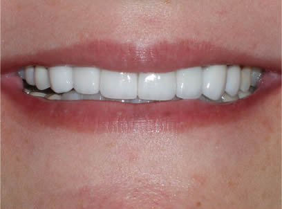 Before & After Smiles from a top-rated dentist Aventura