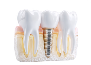 Dental Implants