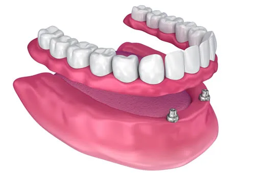 overdentures