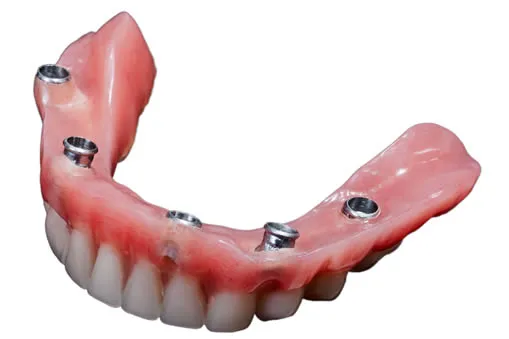 snap-in dentures