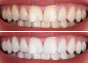Teeth Whitening